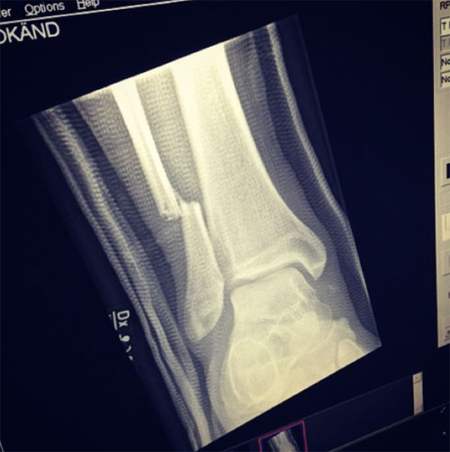 Dlisted | Open Post: Hosted By The X-ray Of Dave Grohl’s Broken Leg