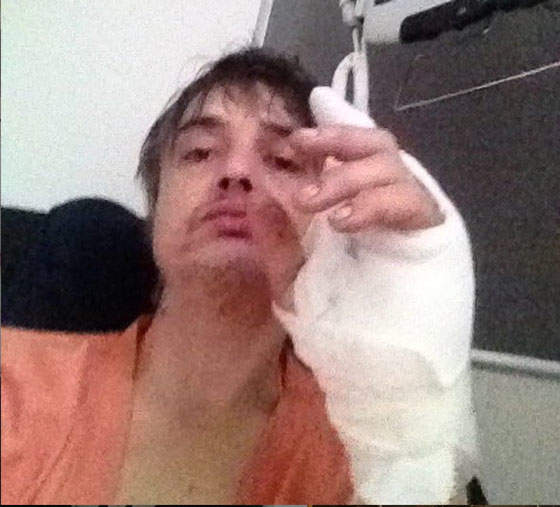 Shit That Would Only Happen To Pete Doherty: He Got Cut Up By A Hedgehog Spike 