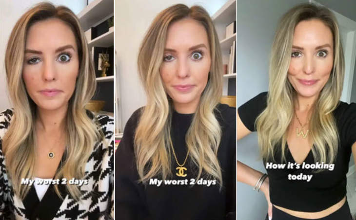 An Influencer Documented What Happens When Botox Goes Wrong