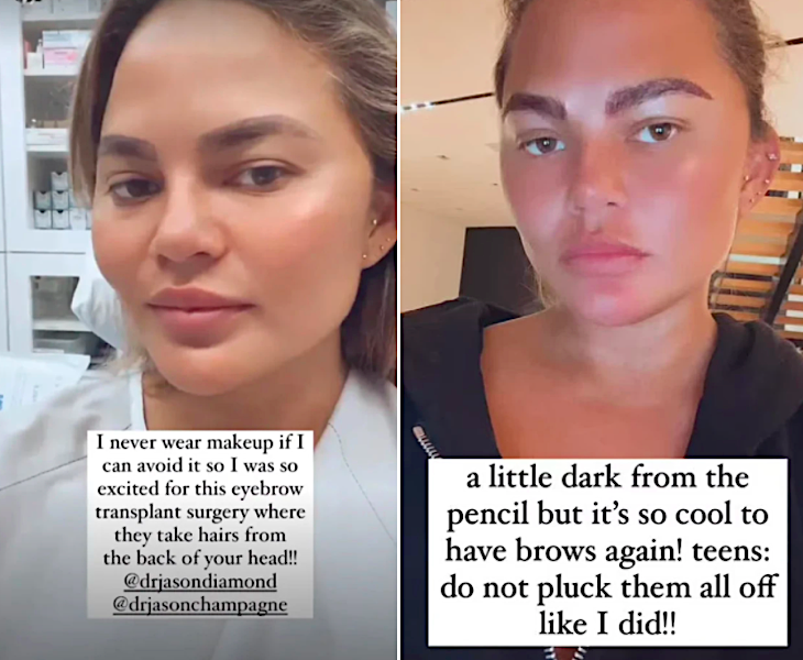 Chrissy Teigen Got An Eyebrow Transplant